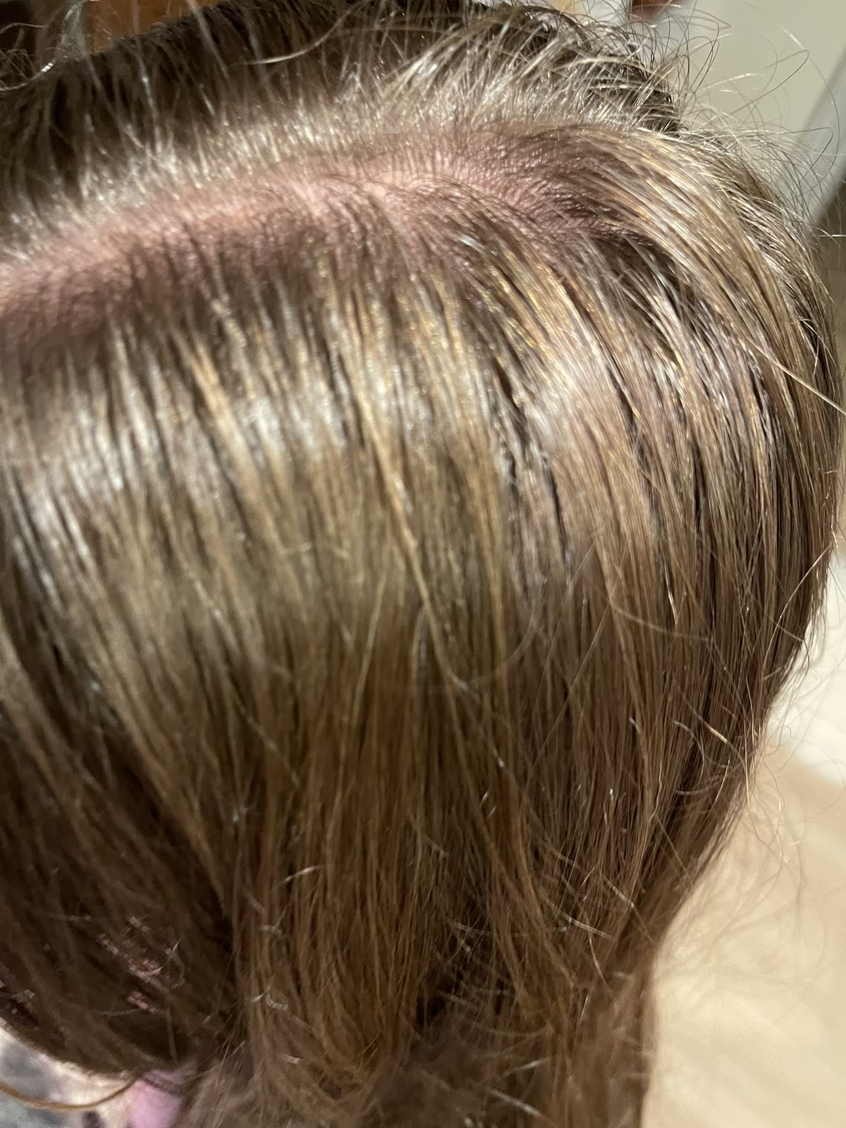 Scalp after using Max Control shampoo — clear scalp with minimal flaking
