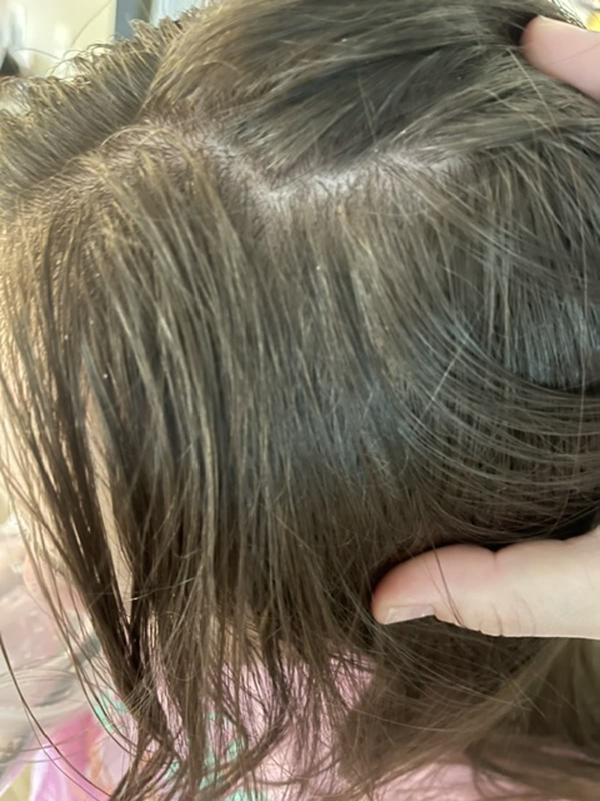 Scalp before using Max Control shampoo — visible dandruff and flakes